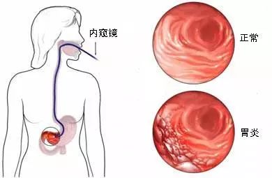 一枚小胶囊，看清你的胃！