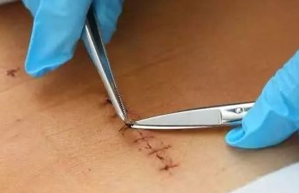 告别缝针，伤口瞬间愈合！医学史上最强黑科技来了！