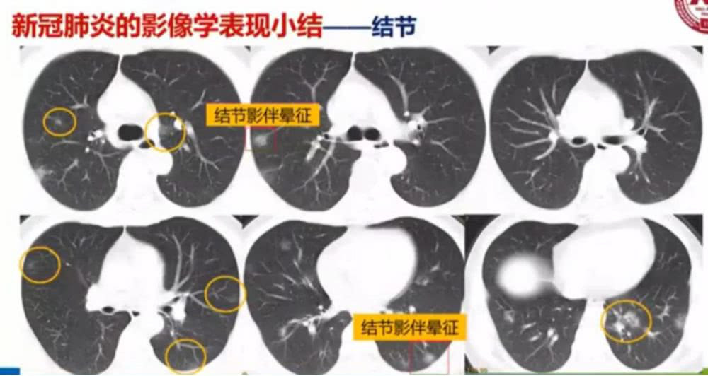 AI助力疫情防控，专利为其保驾护航！