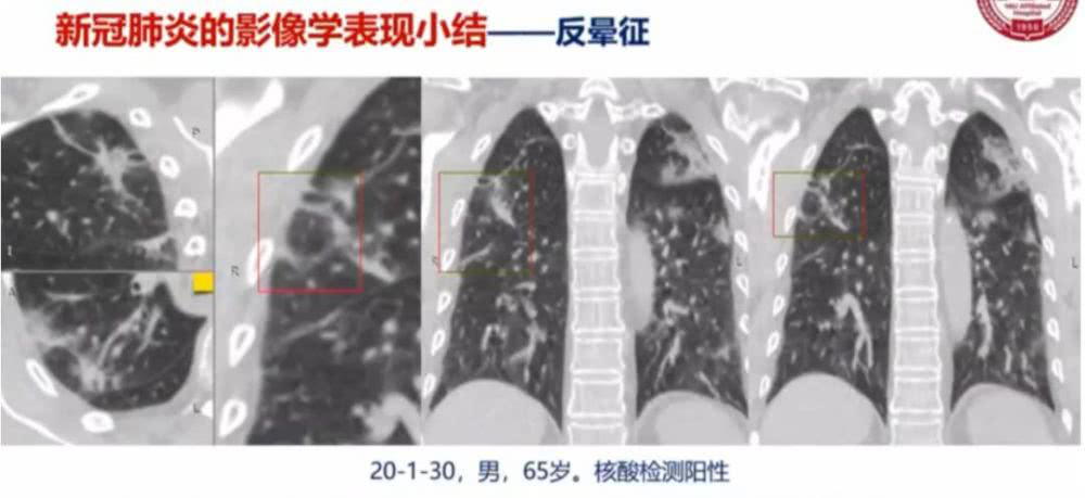 AI助力疫情防控，专利为其保驾护航！